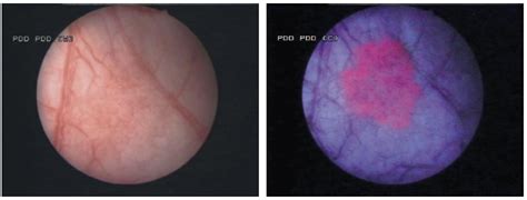 Diagnóstico por Fluorescencia en Tumores Vesicales