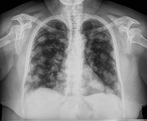 Diagnóstico por Imágenes: Metástasis pulmonares  signo ...