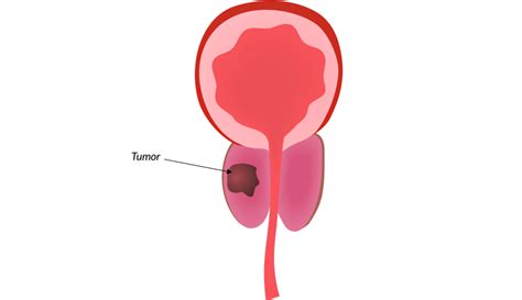 Diagnóstico precoz del cáncer de próstata • Portal de Salud