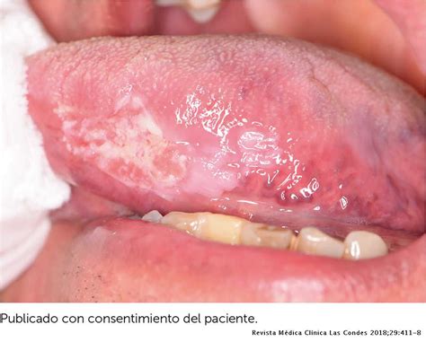 Diagnóstico precoz y prevención en cáncer de cavidad oral ...