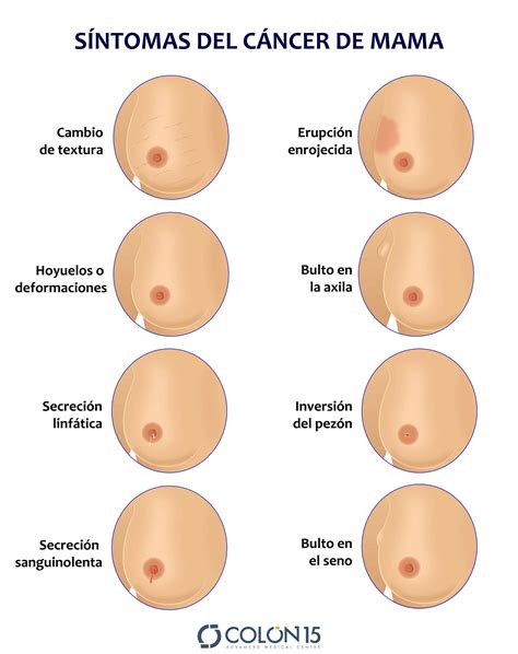 Diagnóstico y seguimiento del cáncer de mama – Colón15 ...