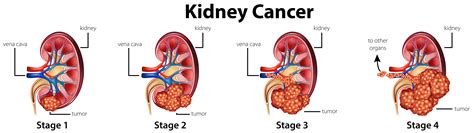 Diagram showing different stages of kidney cancer ...