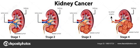 Diagram showing different stages of kidney cancer — Stock ...
