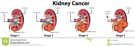 Diagram Showing Different Stages Of Kidney Cancer Stock ...