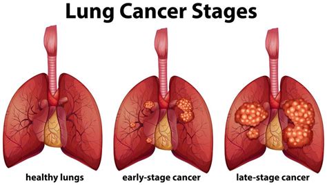 Diagram showing lung cancer stages   Download Free Vectors ...