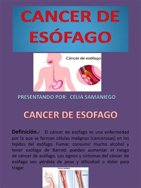 Diapositivas Cancer de Esofago | Cáncer de esófago ...