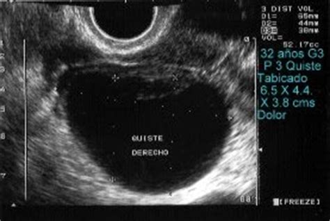 Diario de un Medico II: Quiste Ovarico: Que Recomendar