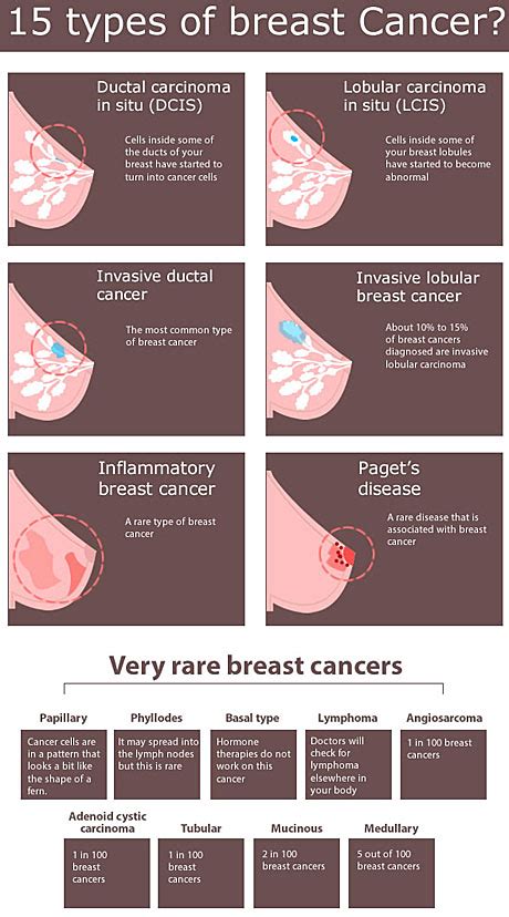 Did you know there are 15 types of breast cancer? Here s ...