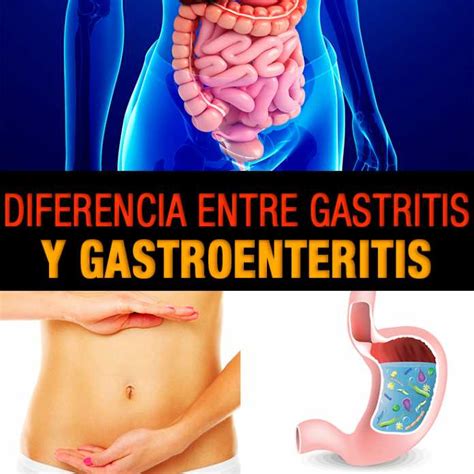 Diferencia entre gastritis y gastroenteritis | La Guía de las Vitaminas