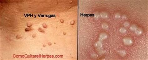 Diferencia entre Herpes Genital y VPH |Virus papiloma humano
