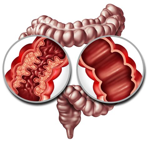 Diferencias entre colitis y gastritis, ¡identifícalas antes de que te ...