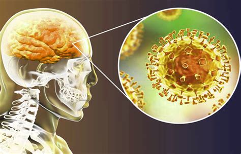 Diferencias entre meningitis y encefalitis – Sooluciona