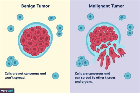 Differences Between a Malignant and Benign Tumor | Lymph ...