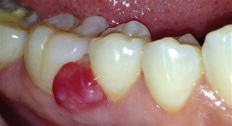 Diplomado en Tumores Benignos de la Cavidad Oral