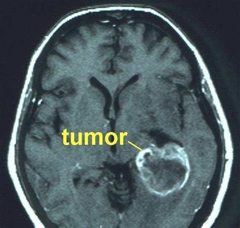 Distintas clases de tumores: Tumores Cerebrales