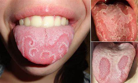 Do YOU have  geographic tongue ? Physicists shed light on ...