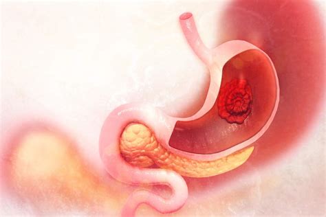Do You Know the Early Signs of Gastric Cancer?   Healthversed