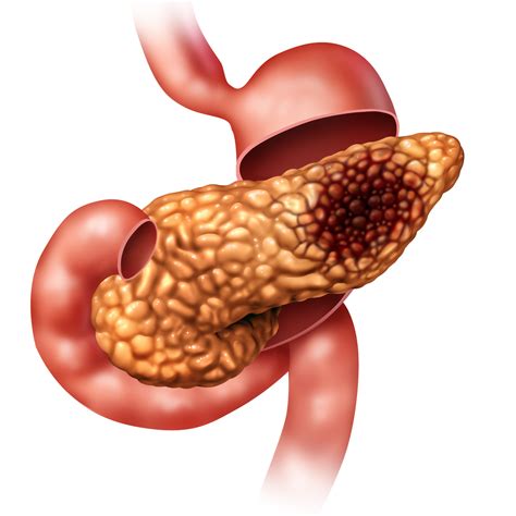 Doctors Discover Why Pancreatic Cancer Kills So Quickly ...