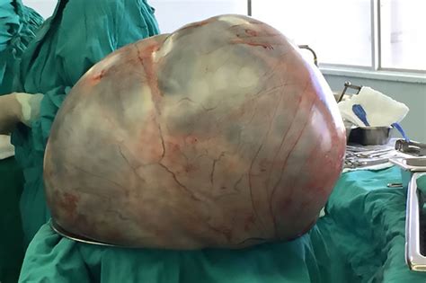 Doctors remove 5st tumour from patient s body in gruesome ...