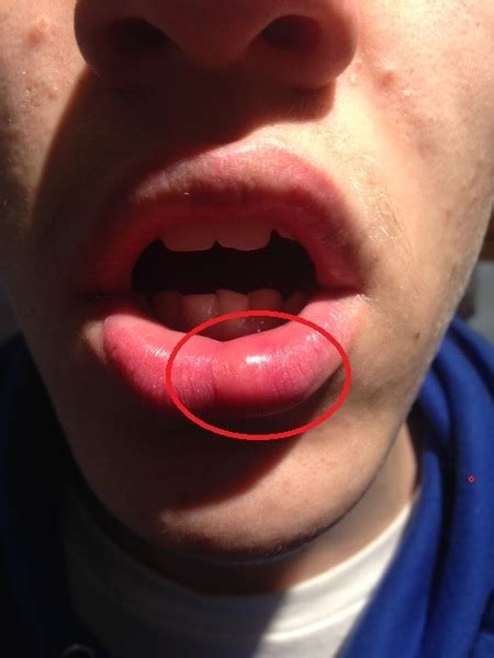 Does this look like a cold sore to you  pic ? **Title ...