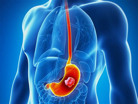 Doubts About Apatinib for Gastric Cancer, Despite Approval