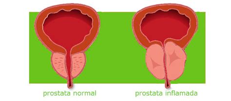 Dprostata   dp: PROSTATITIS