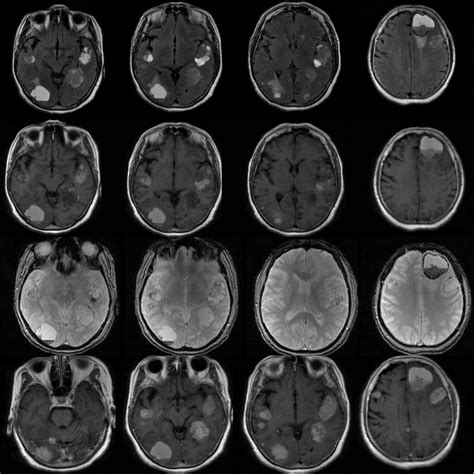 Dr Balaji Anvekar FRCR: Hemorrhagic metastasis MRI Brain