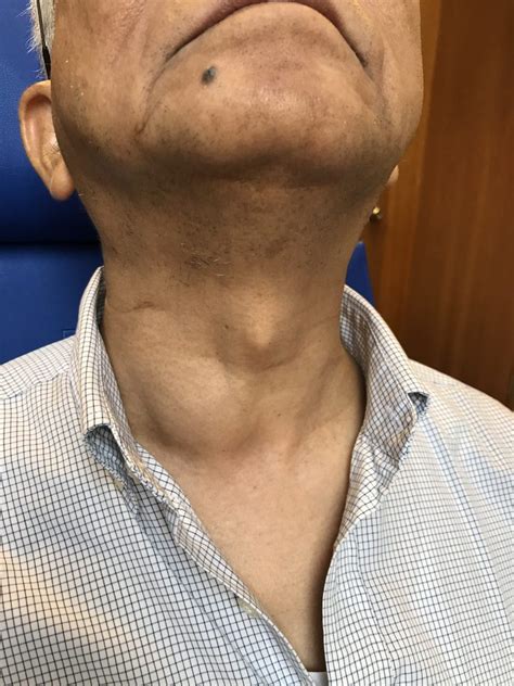 Dr. Dennis Chua’s Complete Guide to Neck Lump issues in Singapore ...