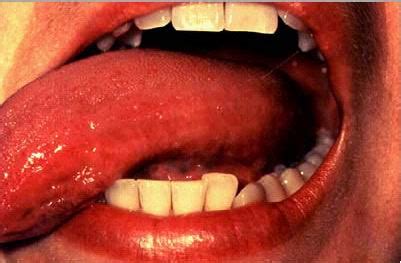 Dr. Frenson Sanon: Enfermedades de la lengua
