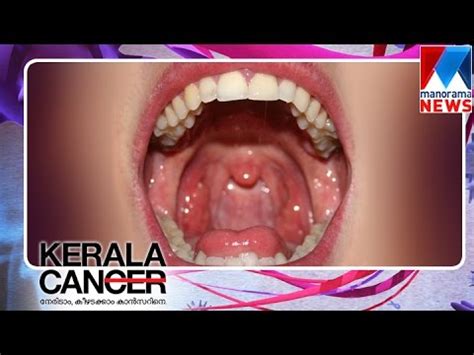 Dr. V.C. Raveendren, speaks about Oral Cancer and ...