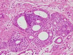 Ductal carcinoma in situ | Australia| PDF | PPT| Case ...
