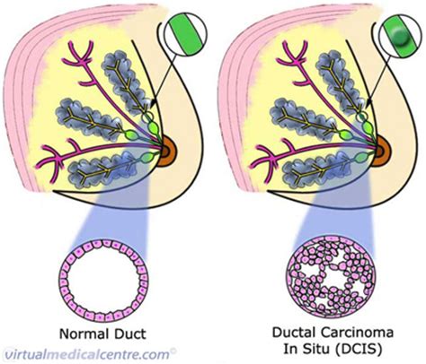 Ductal carcinoma in situ. Causes, symptoms, treatment ...