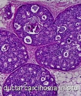 Ductal Carcinoma In Situ, DCIS   Moose and Doc