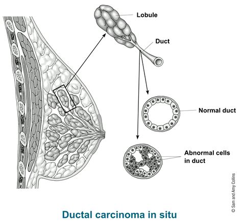 Ductal Carcinoma In Situ  DCIS