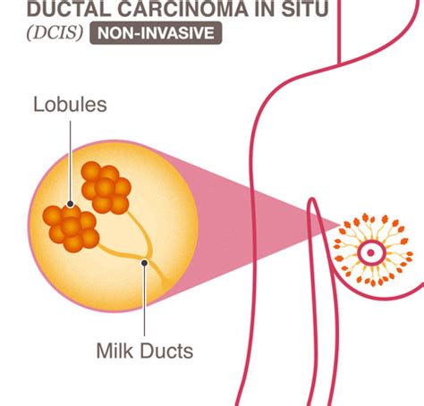 Ductal Carcinoma In Situ  DCIS    National Breast Cancer ...