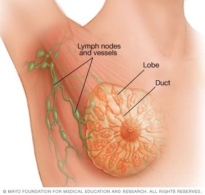 Ductal carcinoma in situ  DCIS    Symptoms and causes ...