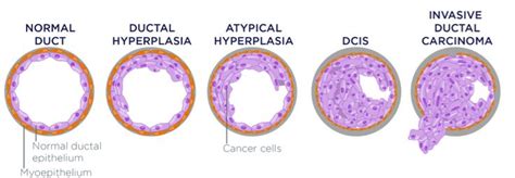 ductal carcinoma in situ stage 3   Google Search | Breast ...