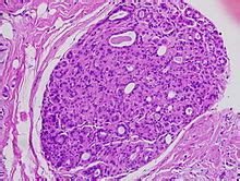 Ductal carcinoma in situ   Wikipedia