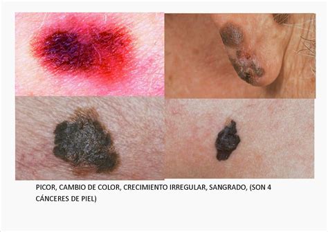 dudas gine: imágenes del cáncer de piel