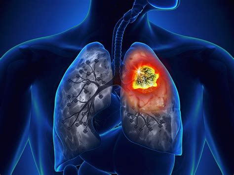 Durvalumab Boosts PFS Even in Stage 3 Lung Cancer