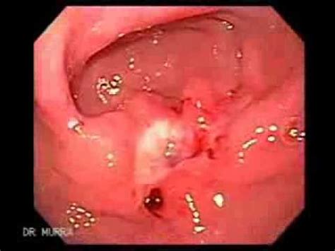 Early Gastric Cancer   YouTube