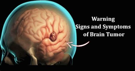 Early Signs and Symptoms of Brain Tumor in Women and Men