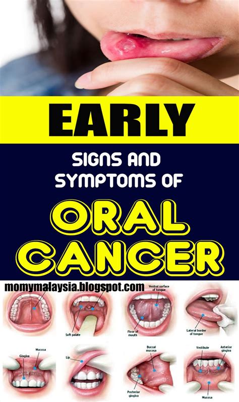 Early Signs and Symptoms of Oral Cancer   Momy Malaysia