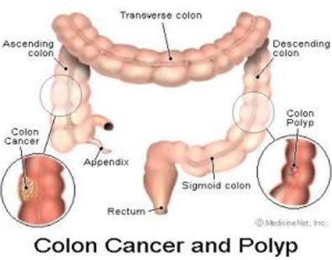 Early signs of colon cancer | General center ...