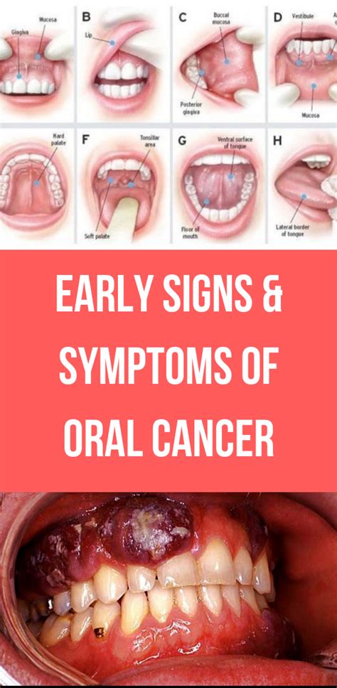 Early Signs & Symptoms of Oral Cancer   Alorabarbie