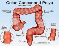 Early Stages of Colon Cancer Symptoms