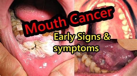 Early Warning Signs of Mouth Cancer Most People Ignore ...