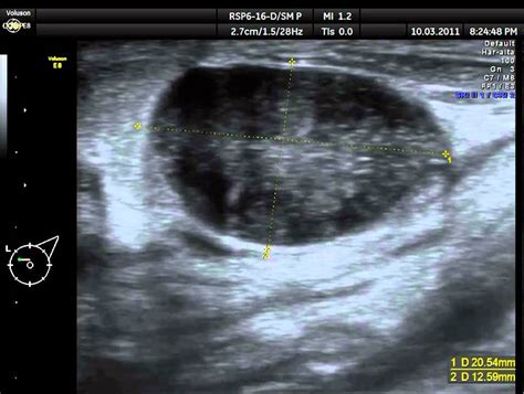 Ecografia 2D Fibroadenoma de mama Clinica Ginecologica Dr. Rafael ...