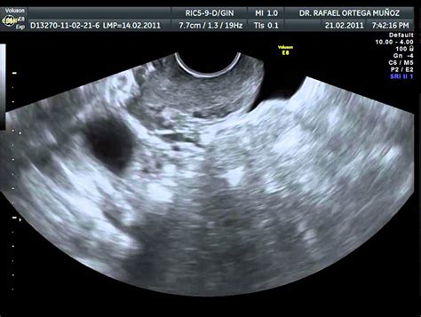 Ecografia 2D Utero y ovario durante la ovulacion Dr.Rafael Ortega Muñoz ...