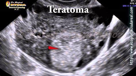 Ecografia Ginecologica 2D Teratoma ovarico o quiste dermoide, Dr ...